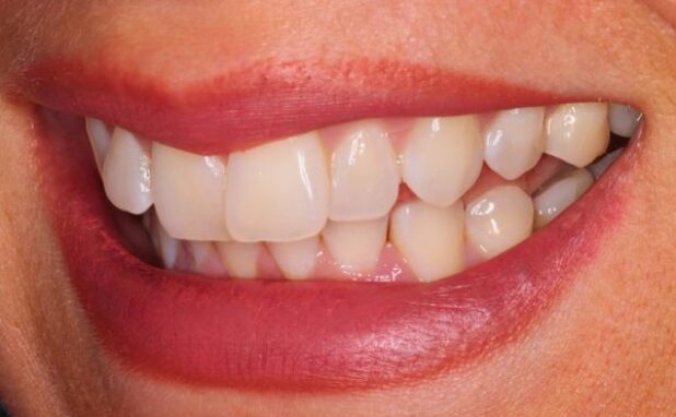 Before - Halo Dental