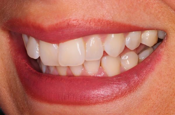 Before - Halo Dental