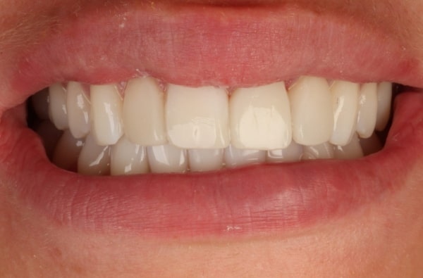 After -Halo Dental