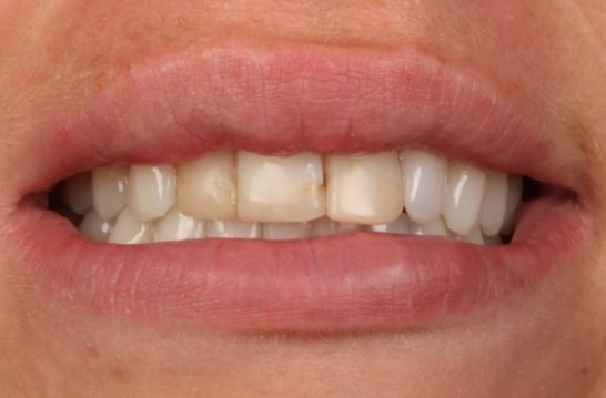 Before - Halo Dental