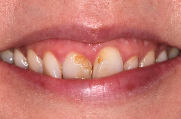 Before - Halo Dental