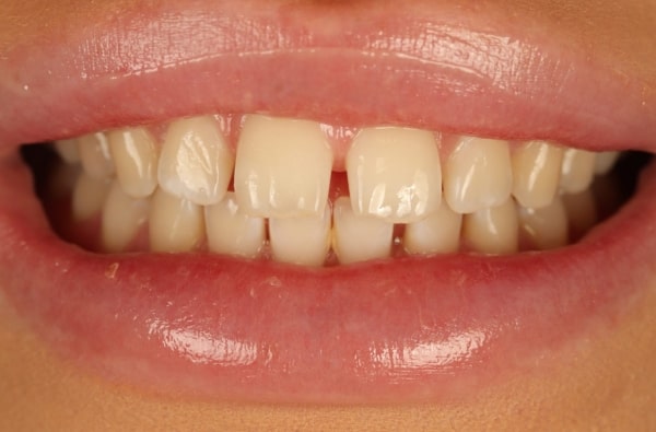 Before - Halo Dental