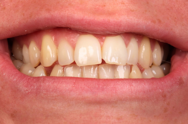 Before - Halo Dental