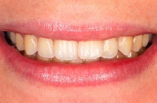 Before - Halo Dental