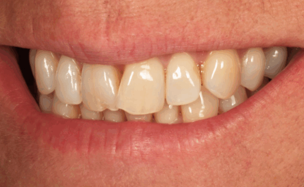 Before - Halo Dental