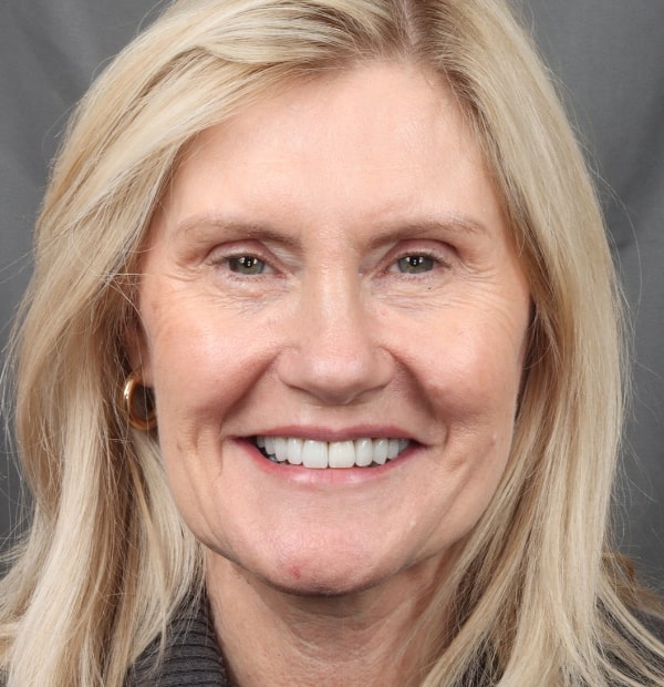 After Face -Halo Dental