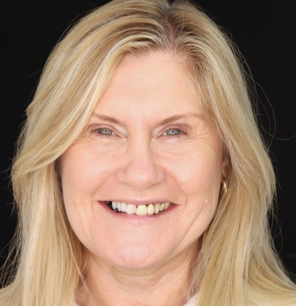 Before Face- Halo Dental