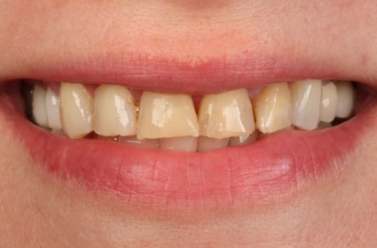 Before - Halo Dental