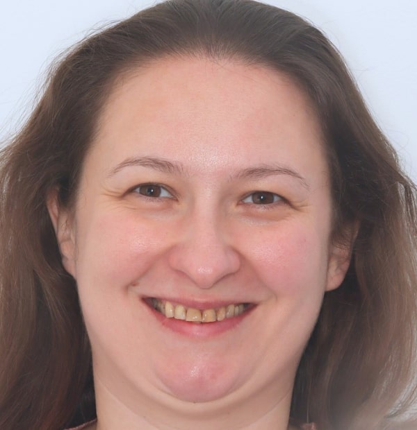 Before Face- Halo Dental