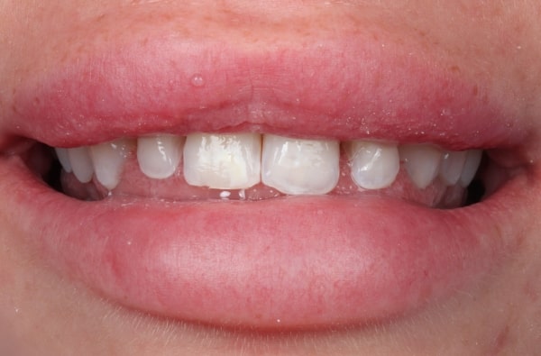 Before - Halo Dental