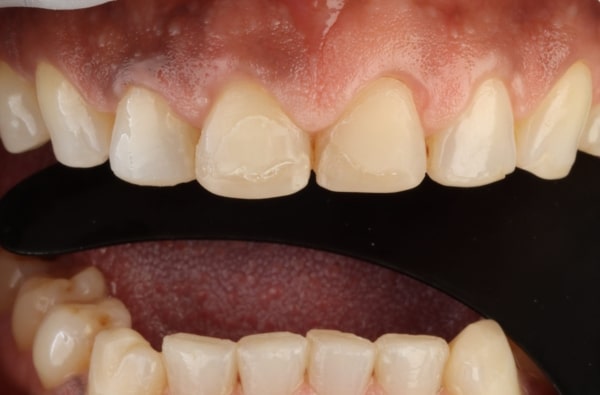 Before - Halo Dental